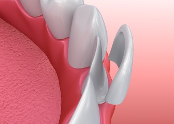 porcelain veneer diagram