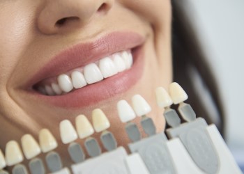 shade guide for veneers